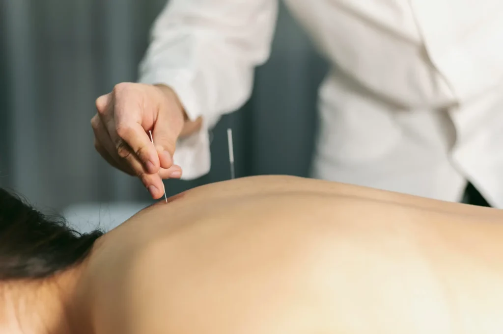 Aplicación de acupuntura en la espalda de una persona durante una sesión terapéutica